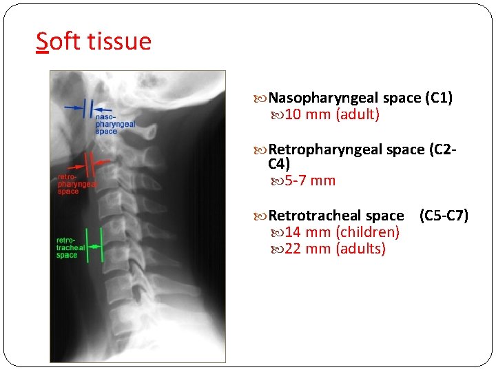 Soft tissue Nasopharyngeal space (C 1) 10 mm (adult) Retropharyngeal space (C 2 -