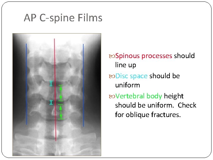 AP C-spine Films Spinous processes should line up Disc space should be uniform Vertebral