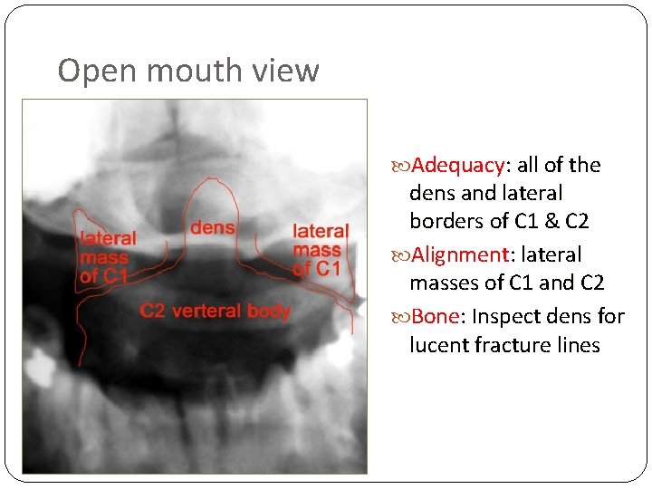 Open mouth view Adequacy: all of the dens and lateral borders of C 1