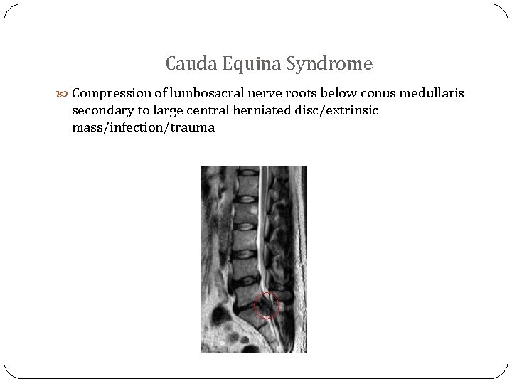 Cauda Equina Syndrome Compression of lumbosacral nerve roots below conus medullaris secondary to large