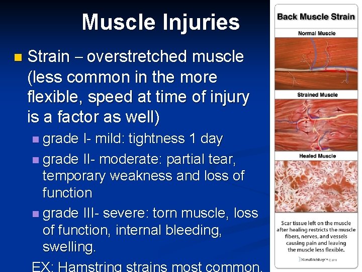 Muscle Injuries n Strain – overstretched muscle (less common in the more flexible, speed