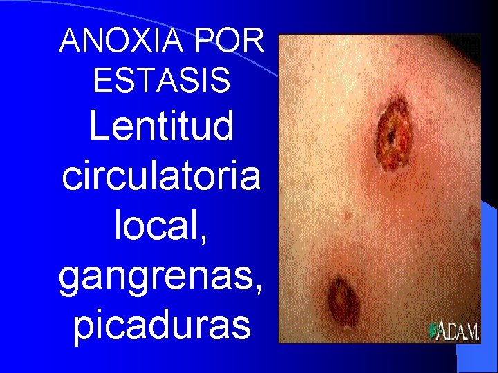 ANOXIA POR ESTASIS Lentitud circulatoria local, gangrenas, picaduras 