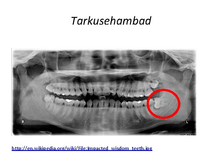 Tarkusehambad http: //en. wikipedia. org/wiki/File: Impacted_wisdom_teeth. jpg 