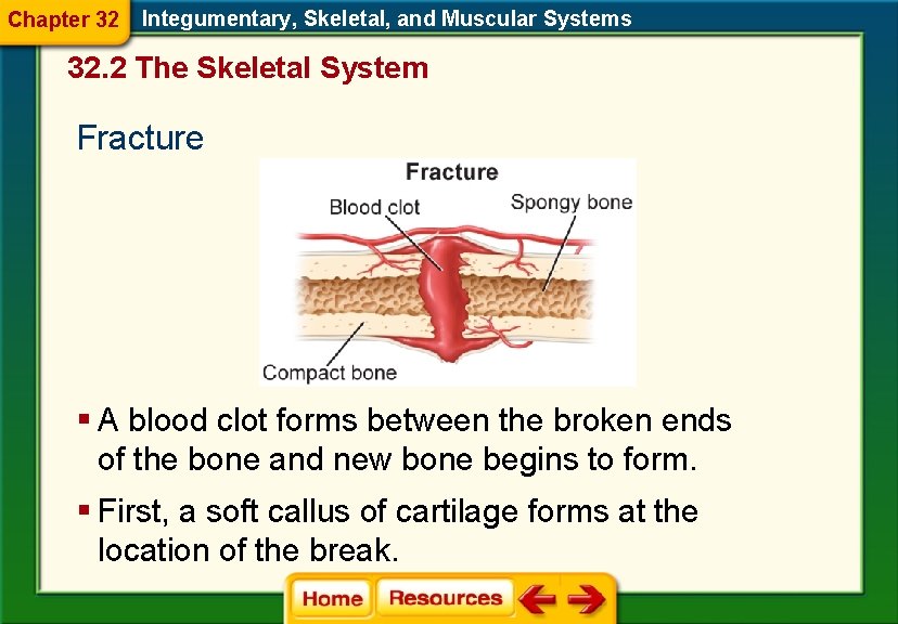Chapter 32 Integumentary, Skeletal, and Muscular Systems 32. 2 The Skeletal System Fracture §