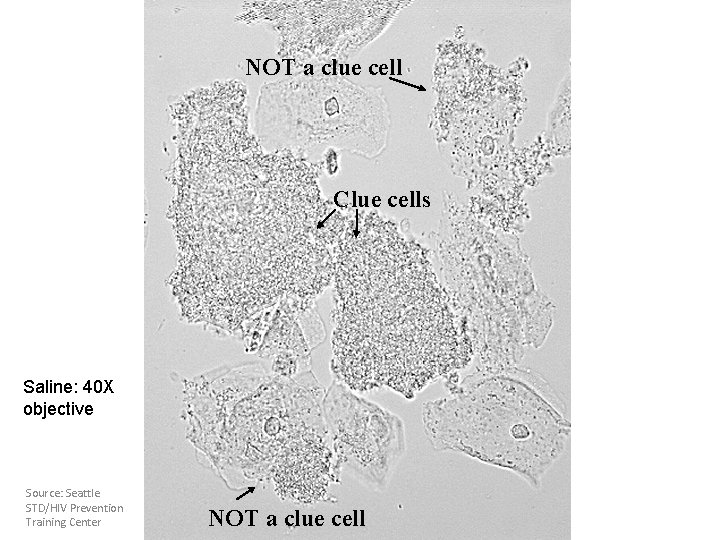 NOT a clue cell Clue cells Saline: 40 X objective Source: Seattle STD/HIV Prevention