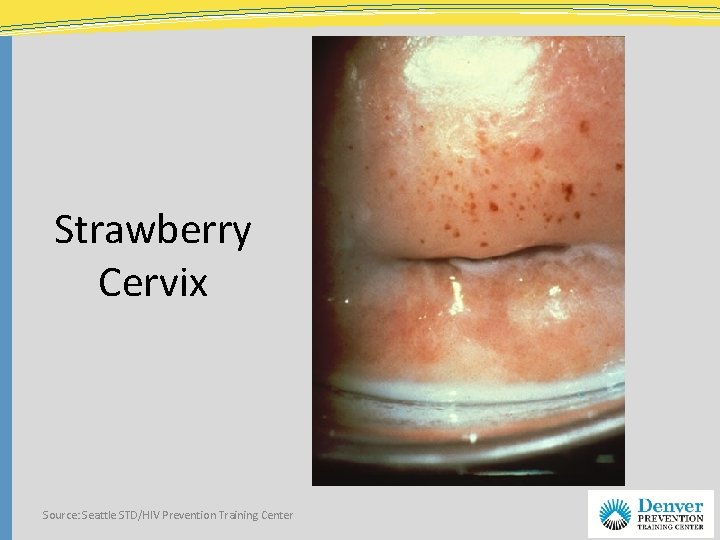 Strawberry Cervix Source: Seattle STD/HIV Prevention Training Center 