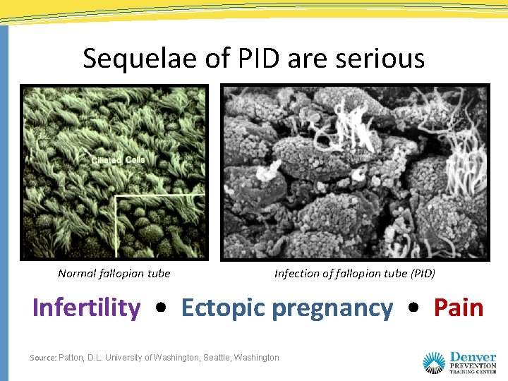 Sequelae of PID are serious Normal fallopian tube Infection of fallopian tube (PID) Infertility