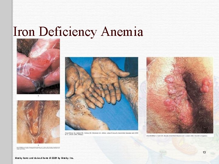 Iron Deficiency Anemia 13 Mosby items and derived items © 2006 by Mosby, Inc.