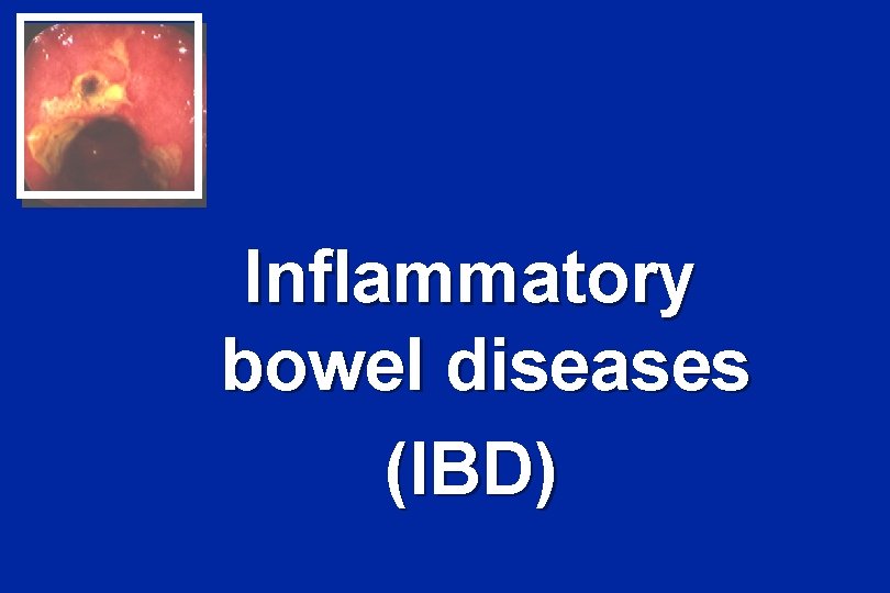 Inflammatory bowel diseases (IBD) 