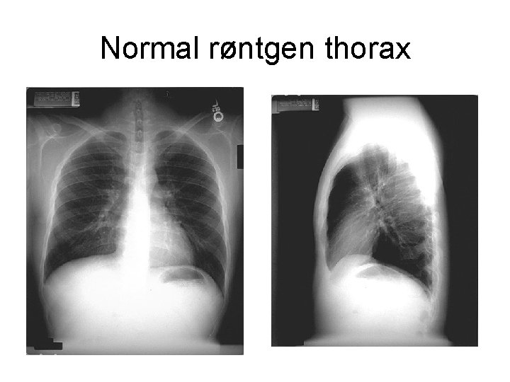 Normal røntgen thorax 
