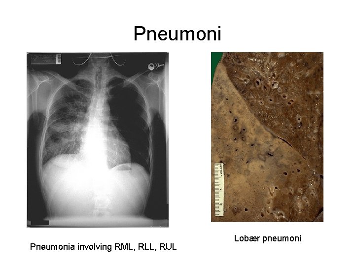 Pneumonia involving RML, RLL, RUL Lobær pneumoni 