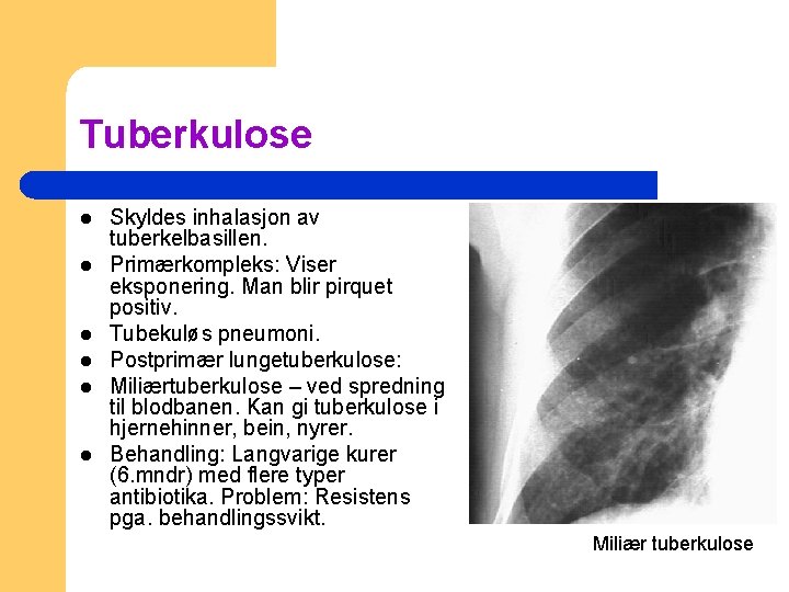 Tuberkulose l l l Skyldes inhalasjon av tuberkelbasillen. Primærkompleks: Viser eksponering. Man blir pirquet