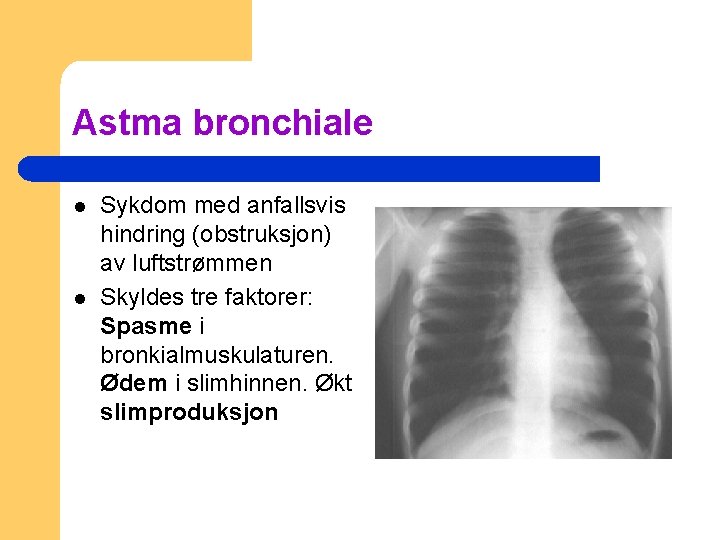 Astma bronchiale l l Sykdom med anfallsvis hindring (obstruksjon) av luftstrømmen Skyldes tre faktorer: