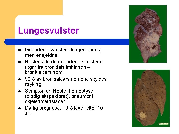 Lungesvulster l l l Godartede svulster i lungen finnes, men er sjeldne. Nesten alle