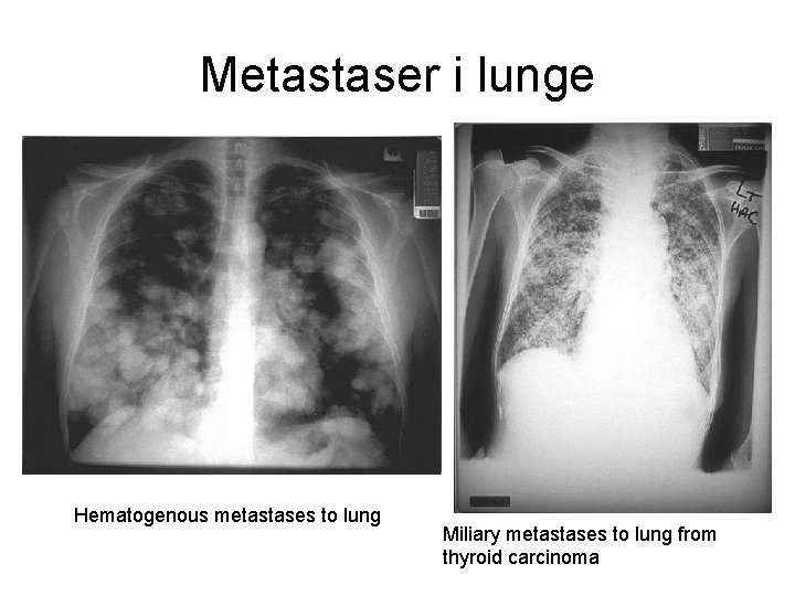 Metastaser i lunge Hematogenous metastases to lung Miliary metastases to lung from thyroid carcinoma