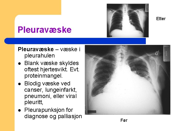 Etter Pleuravæske – væske i pleurahulen l Blank væske skyldes oftest hjertesvikt. Evt. proteinmangel.