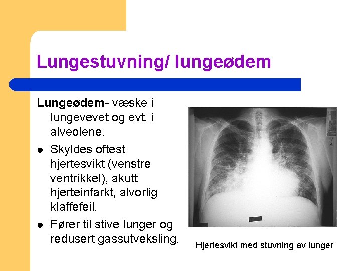 Lungestuvning/ lungeødem Lungeødem- væske i lungevevet og evt. i alveolene. l Skyldes oftest hjertesvikt