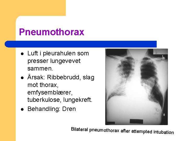 Pneumothorax l l l Luft i pleurahulen som presser lungevevet sammen. Årsak: Ribbebrudd, slag