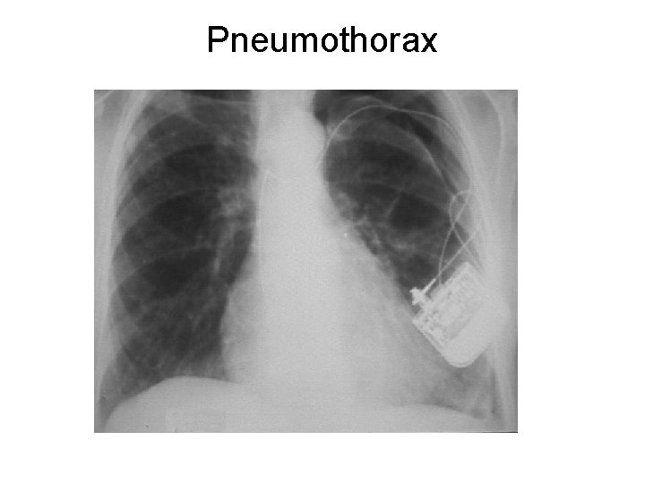 Pneumothorax 