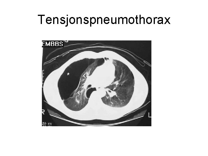 Tensjonspneumothorax 