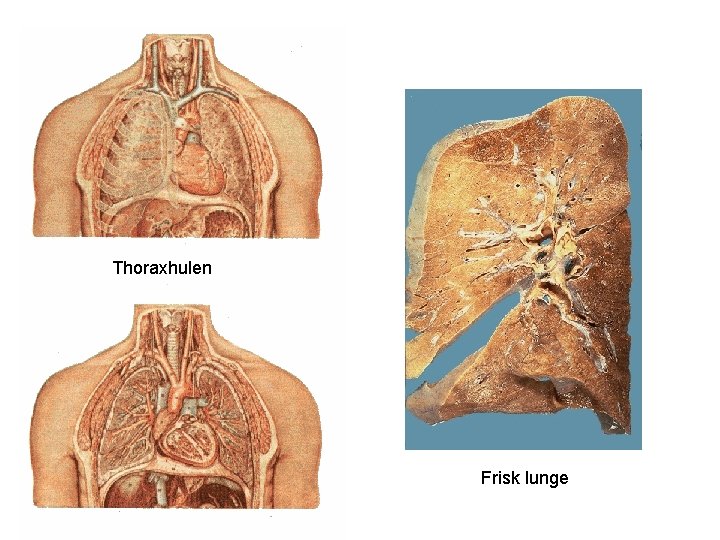 Thoraxhulen Frisk lunge 
