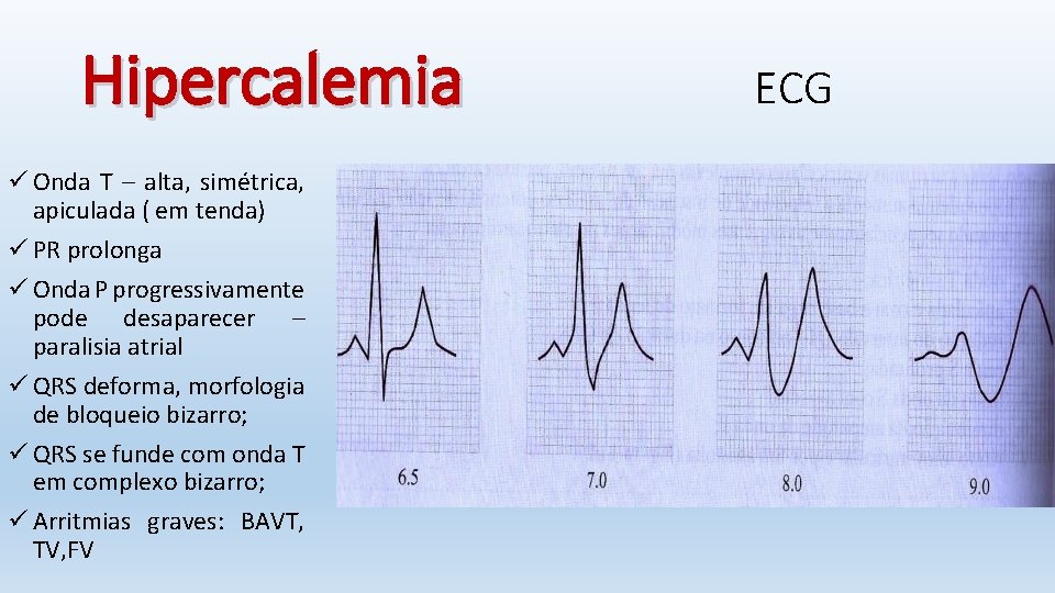 Hipercalemia ü Onda T – alta, simétrica, apiculada ( em tenda) ü PR prolonga