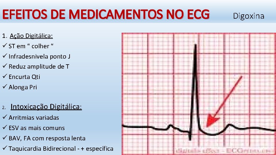 EFEITOS DE MEDICAMENTOS NO ECG 1. Ação Digitálica: ü ST em “ colher “