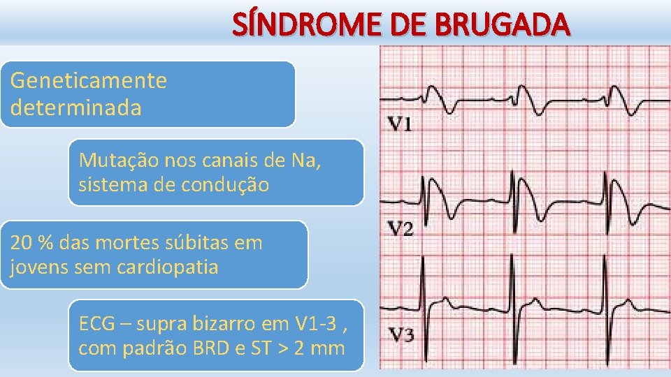 SÍNDROME DE BRUGADA Geneticamente determinada Mutação nos canais de Na, sistema de condução 20