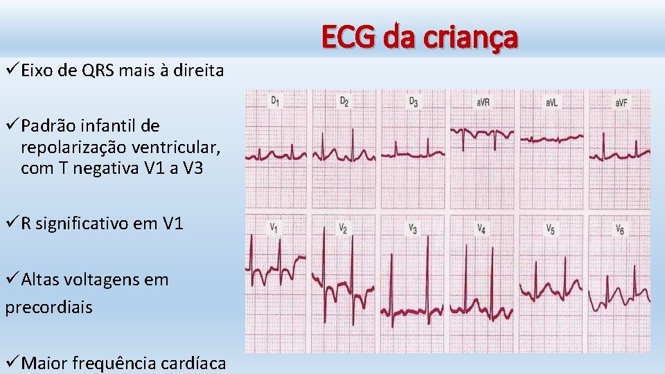 ECG da criança üEixo de QRS mais à direita üPadrão infantil de repolarização ventricular,
