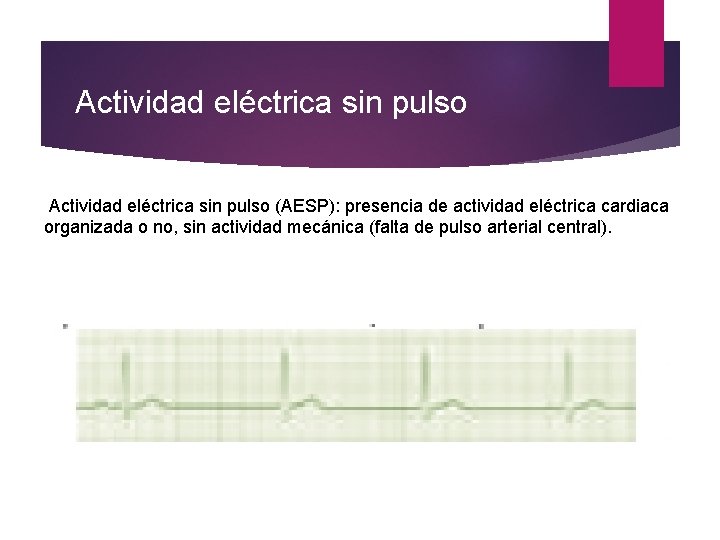 Actividad eléctrica sin pulso (AESP): presencia de actividad eléctrica cardiaca organizada o no, sin