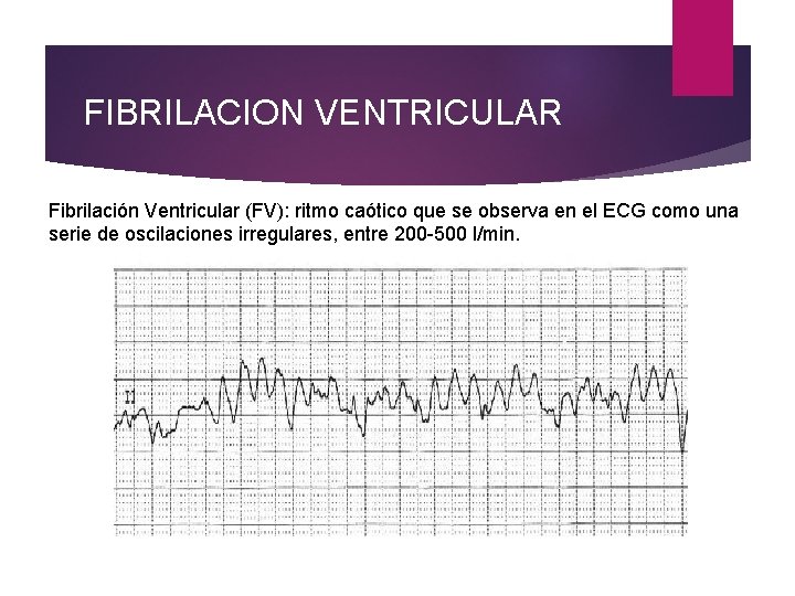 FIBRILACION VENTRICULAR Fibrilación Ventricular (FV): ritmo caótico que se observa en el ECG como