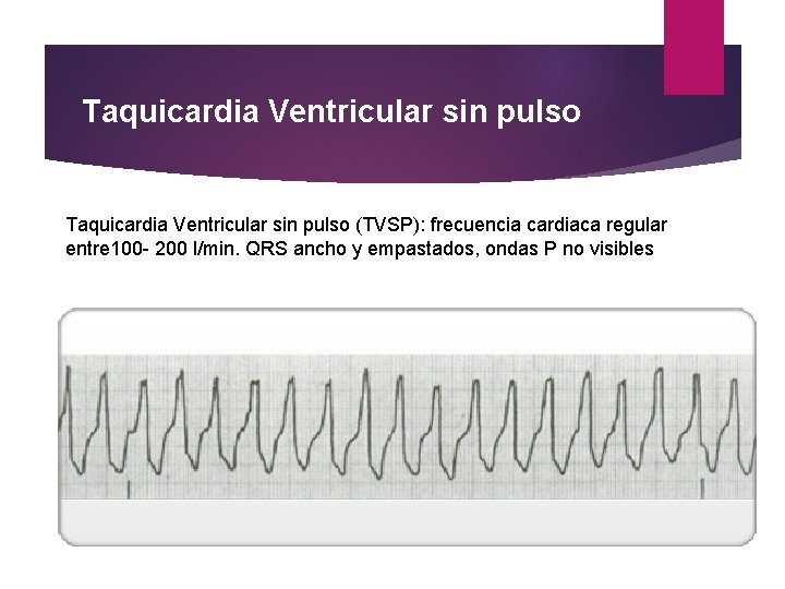 Taquicardia Ventricular sin pulso (TVSP): frecuencia cardiaca regular entre 100 - 200 l/min. QRS