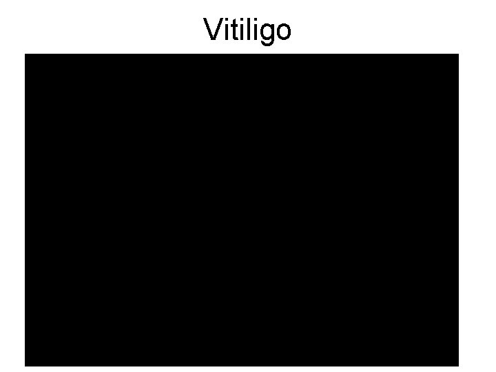 Vitiligo 