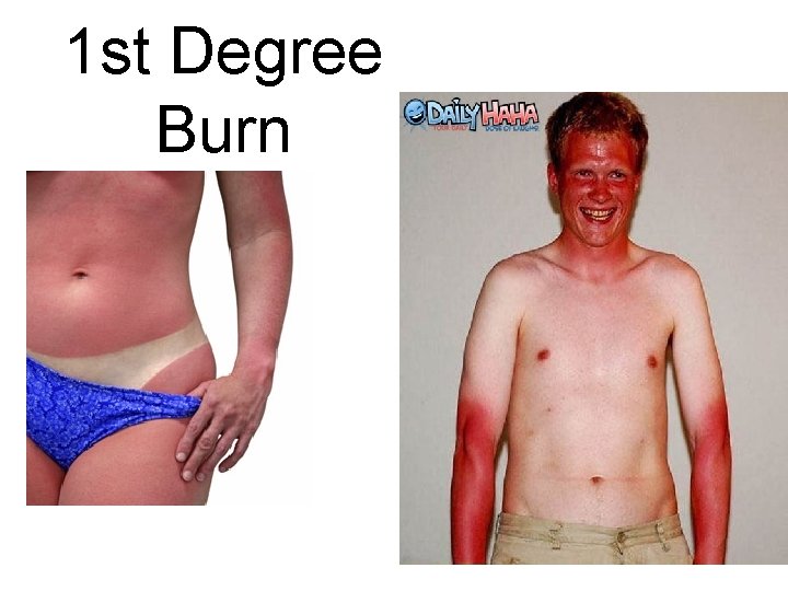 1 st Degree Burn 