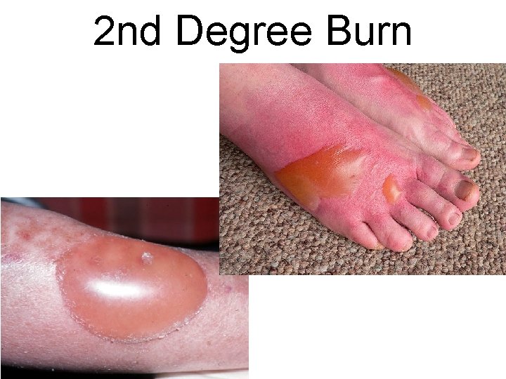 2 nd Degree Burn 2 nd Degree Burn