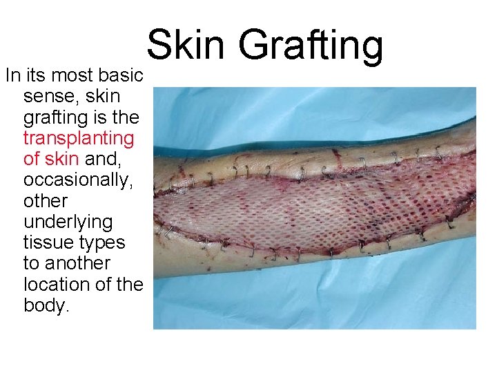 In its most basic sense, skin grafting is the transplanting of skin and, occasionally,