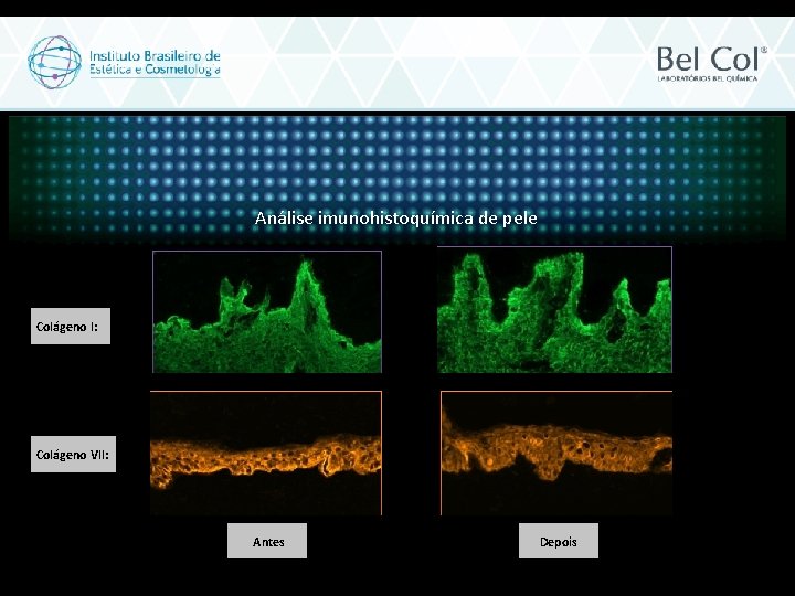 Análise imunohistoquímica de pele Colágeno I: Colágeno VII: Antes Depois 