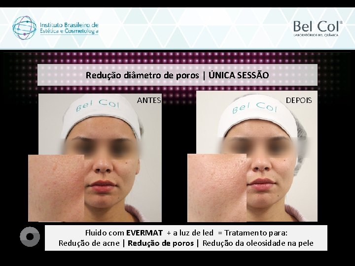 Redução diâmetro de poros | ÚNICA SESSÃO ANTES DEPOIS Fluido com EVERMAT + a