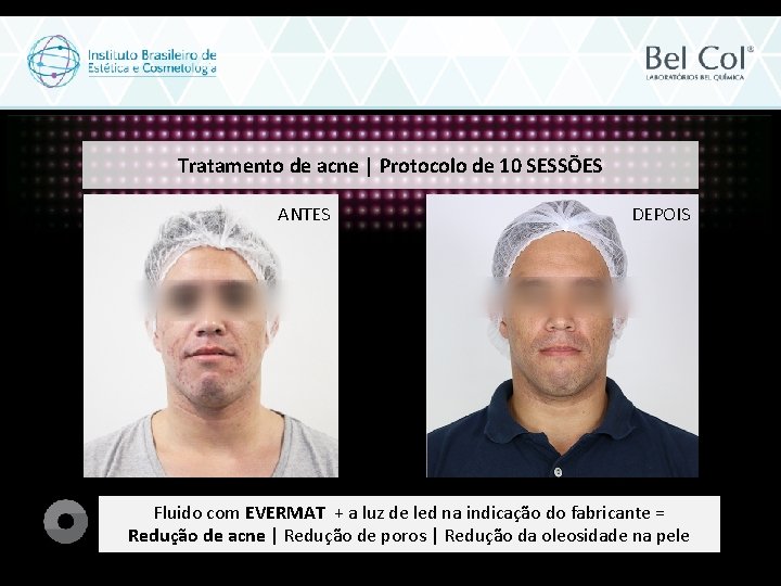 Tratamento de acne | Protocolo de 10 SESSÕES ANTES DEPOIS Fluido com EVERMAT +