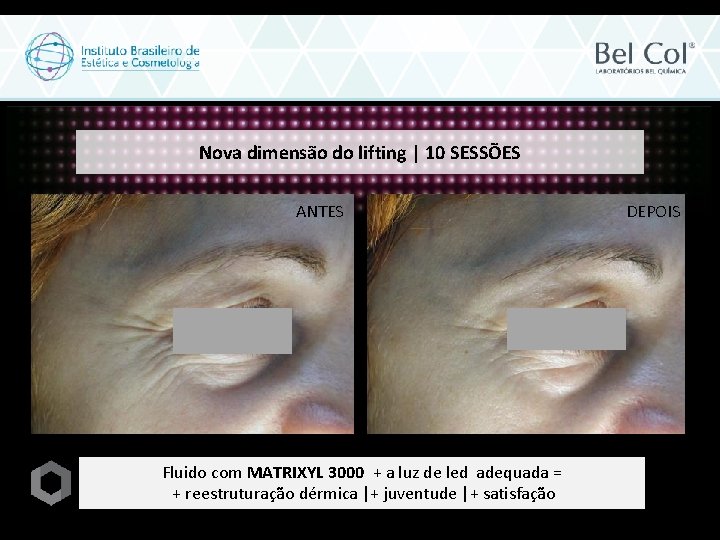 Nova dimensão do lifting | 10 SESSÕES ANTES Fluido com MATRIXYL 3000 + a