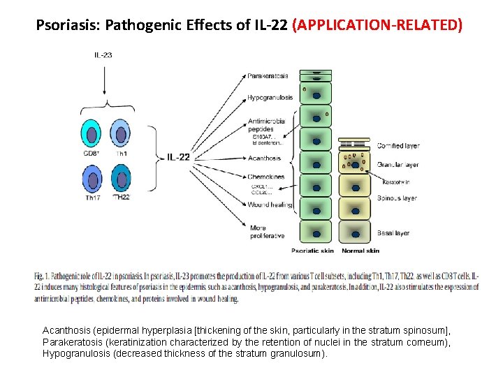 Psoriasis: Pathogenic Effects of IL-22 (APPLICATION-RELATED) Acanthosis (epidermal hyperplasia [thickening of the skin, particularly