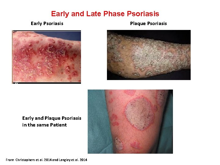 Early and Late Phase Psoriasis Early Psoriasis Plaque Psoriasis Early and Plaque Psoriasis in
