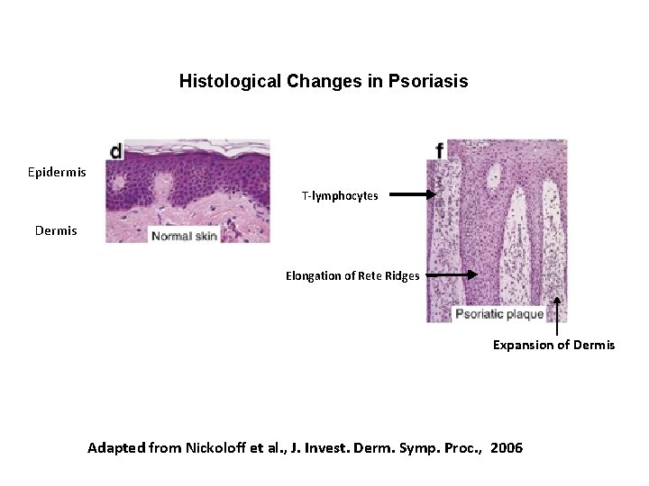 Histological Changes in Psoriasis Epidermis T-lymphocytes Dermis Elongation of Rete Ridges Expansion of Dermis