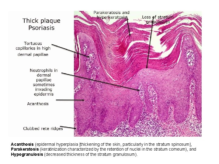 Acanthosis (epidermal hyperplasia [thickening of the skin, particularly in the stratum spinosum], Parakeratosis (keratinization