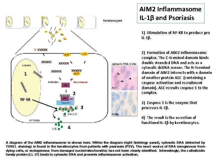 AIM 2 Inflammasome IL-1β and Psoriasis 1) Stimulation of NF-KB to produce pro IL-1β.