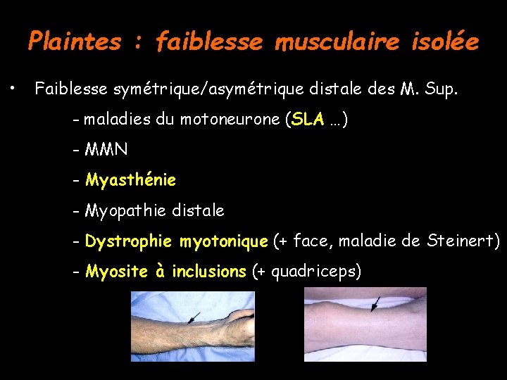 Plaintes : faiblesse musculaire isolée • Faiblesse symétrique/asymétrique distale des M. Sup. - maladies