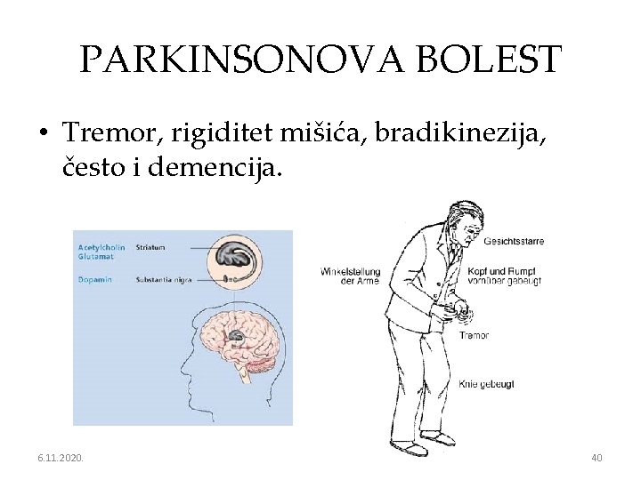 PARKINSONOVA BOLEST • Tremor, rigiditet mišića, bradikinezija, često i demencija. 6. 11. 2020. 40