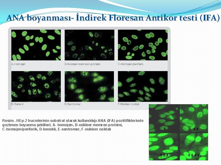 ANA boyanması- İndirek Floresan Antikor testi (IFA) Resim. HEp-2 hucrelerinin substrat olarak kullanıldığı ANA