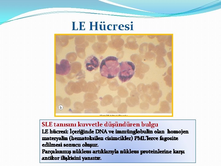 LE Hücresi SLE tanısını kuvvetle düşündüren bulgu LE hücresi: İçeriğinde DNA ve immünglobulin olan