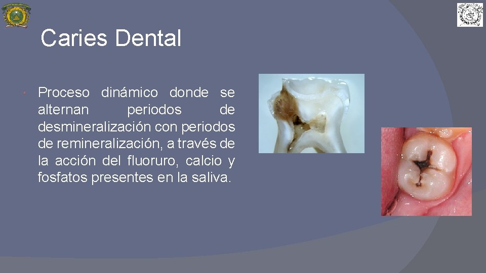 Caries Dental Proceso dinámico donde se alternan periodos de desmineralización con periodos de remineralización,